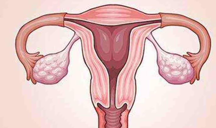 试管婴儿时多囊卵巢综合症患者需要注意哪些事项内附身体调理